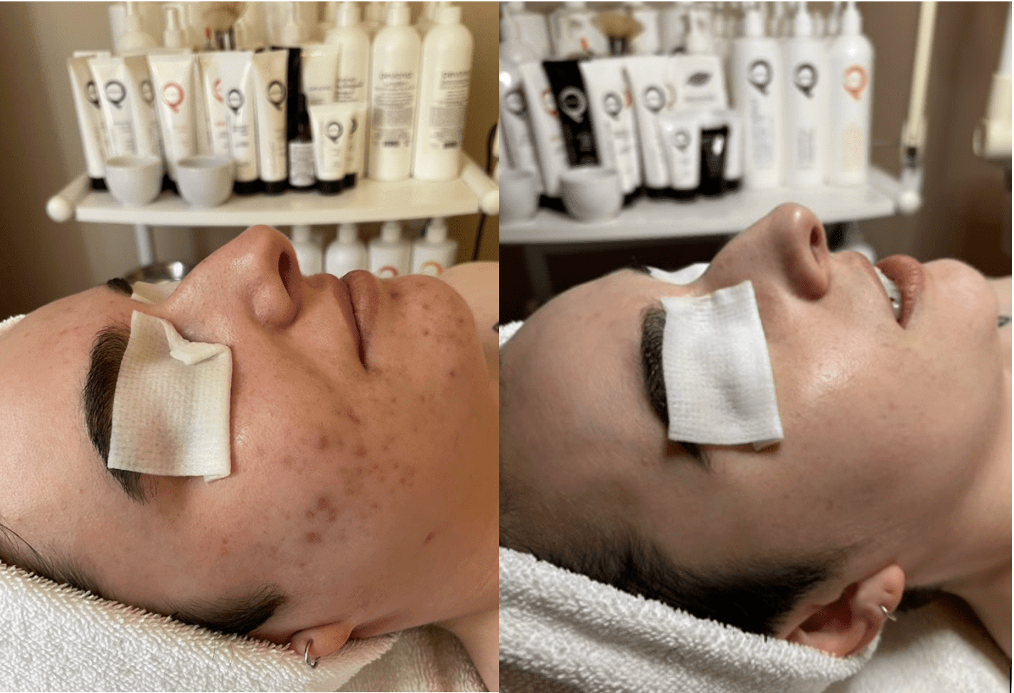 Curative Acne Facial Treatments at John Francis Spa San Francisco