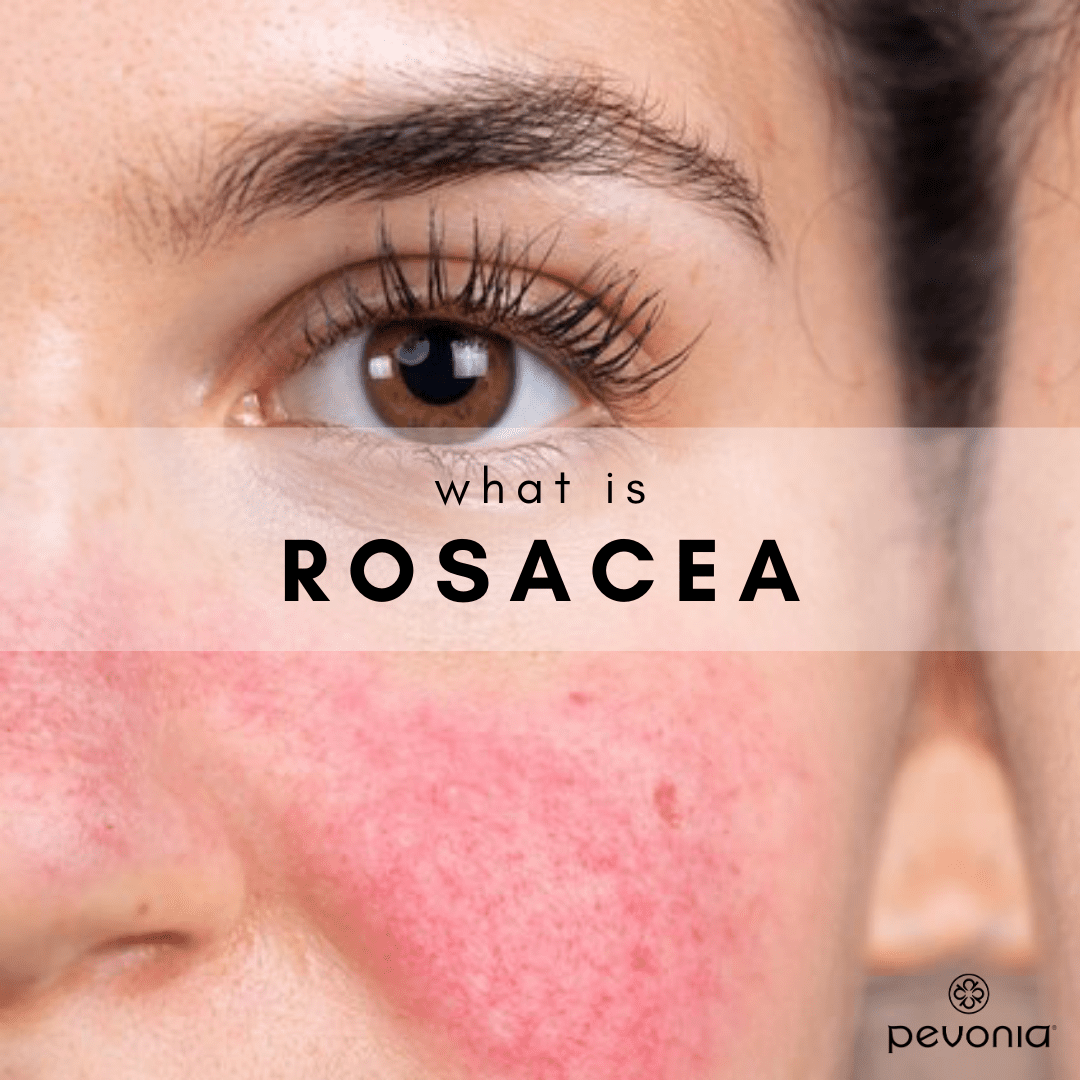 Pevonia Curative RS2 Rosacea Facial at John Francis Spa