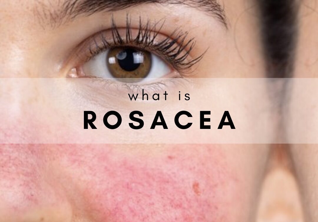 Skincare Rule #5 Treat the Sensitivity First at John Francis Spa