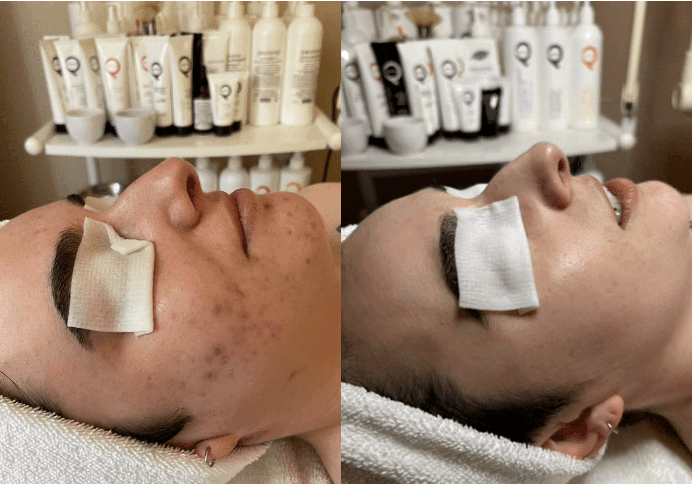 Curative Acne Facial Treatments at John Francis Spa San Francisco